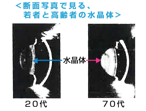 20代と、70代の水晶体断面図比較